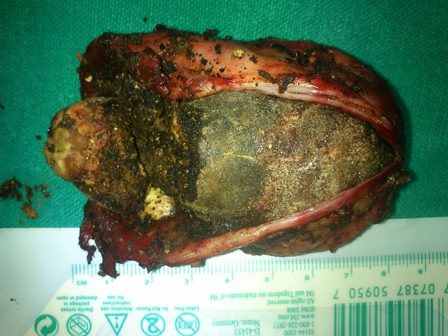 Largest Gall Bladder Stone Removed by Laparoscopic Surgery