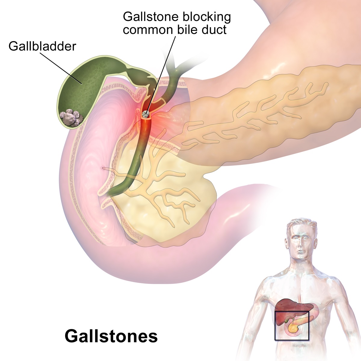 Gallstones Laparoscopic Surgery