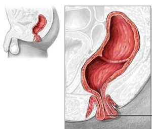Rectal Prolapse Treatment in Delhi