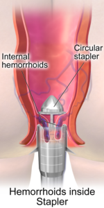 Stapler Hemorrhoidopexy