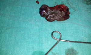 Anal Abscess & Fistula Treatment in Delhi