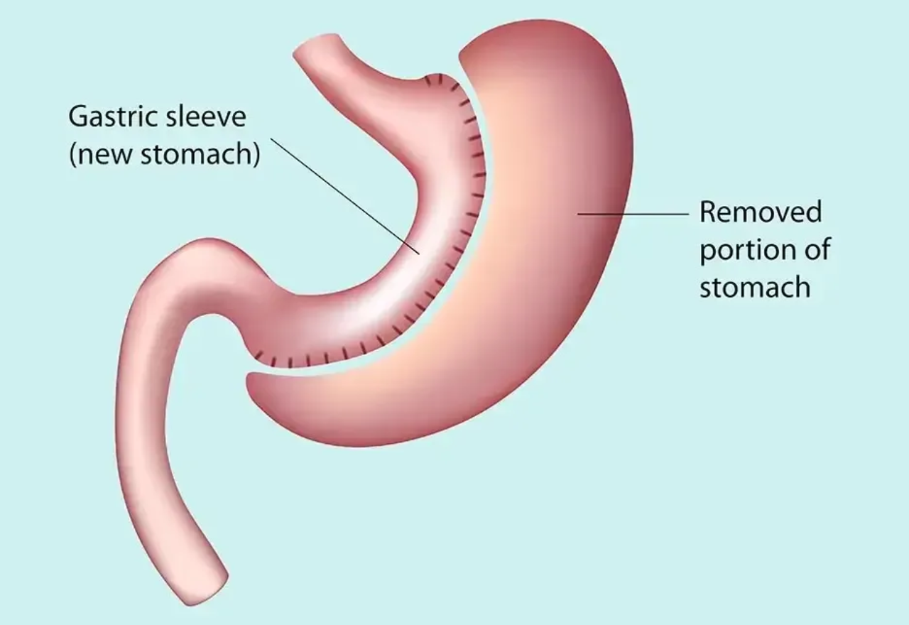 Sleeve Gastrectomy