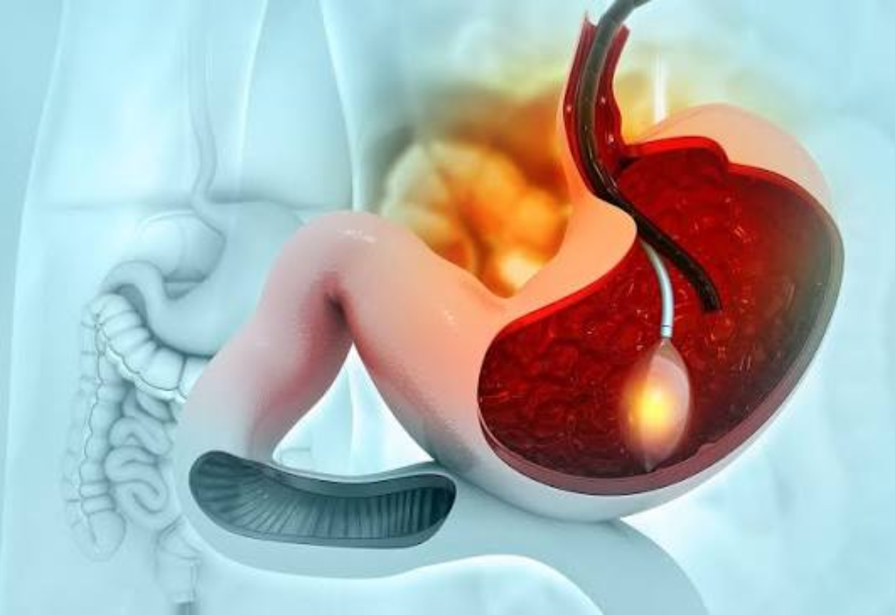 Gastric Bypass