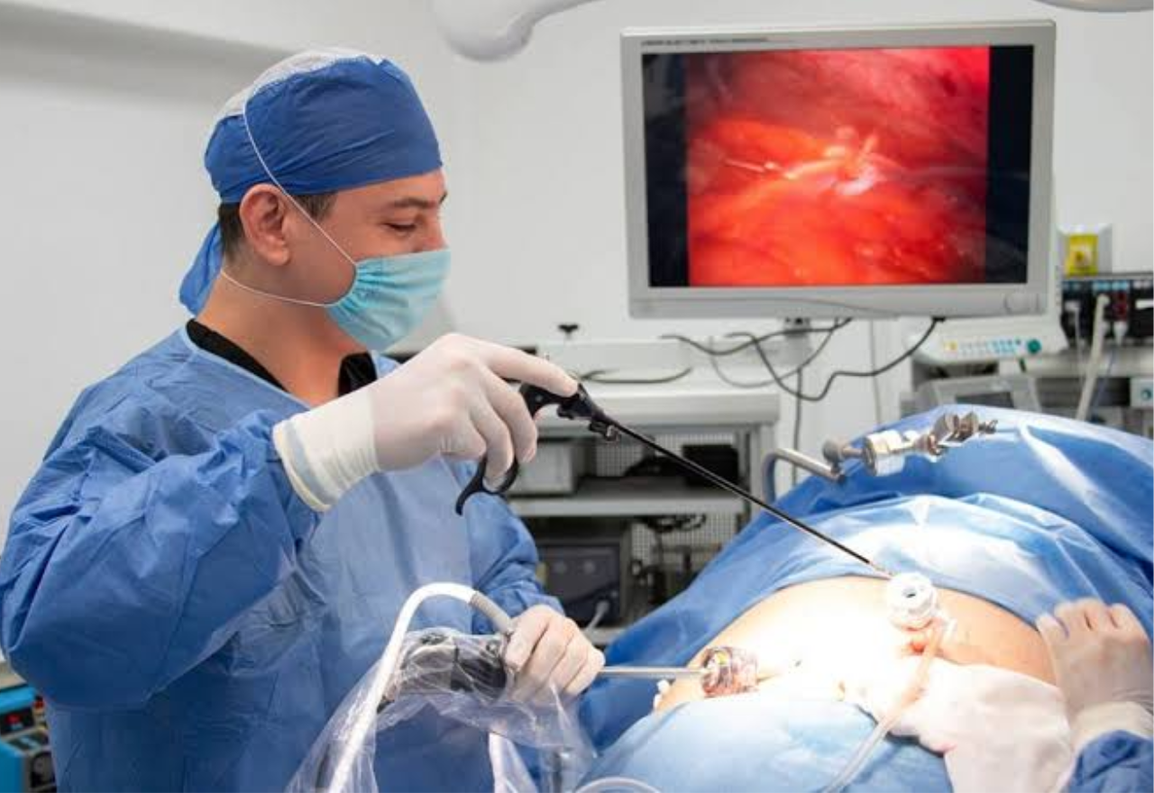 Mini Gastric Bypass